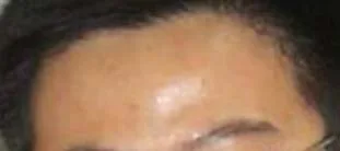 Trán gồ nổi thành vòng cung trên ấn đường