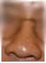 Sơn căn thấp và gãy